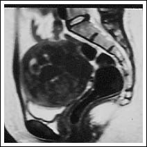 At 26th January 1999 - apparent total replacement of uterine musculature by fibroids.