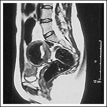 At 9th February 1999. Post embolisation scan showing marked shrinkage of fibroid.