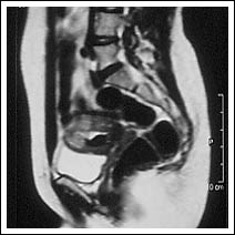 At 21st July 1998 - post embolisation showing 90% shrinkage of fibroid.