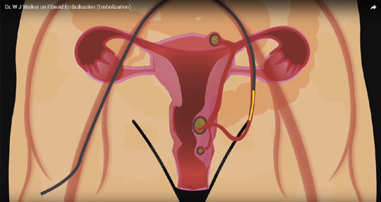 Dr. Walker uterine fibroids